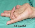 /album/fotogaleria/dedo-engatillado-jpg/
